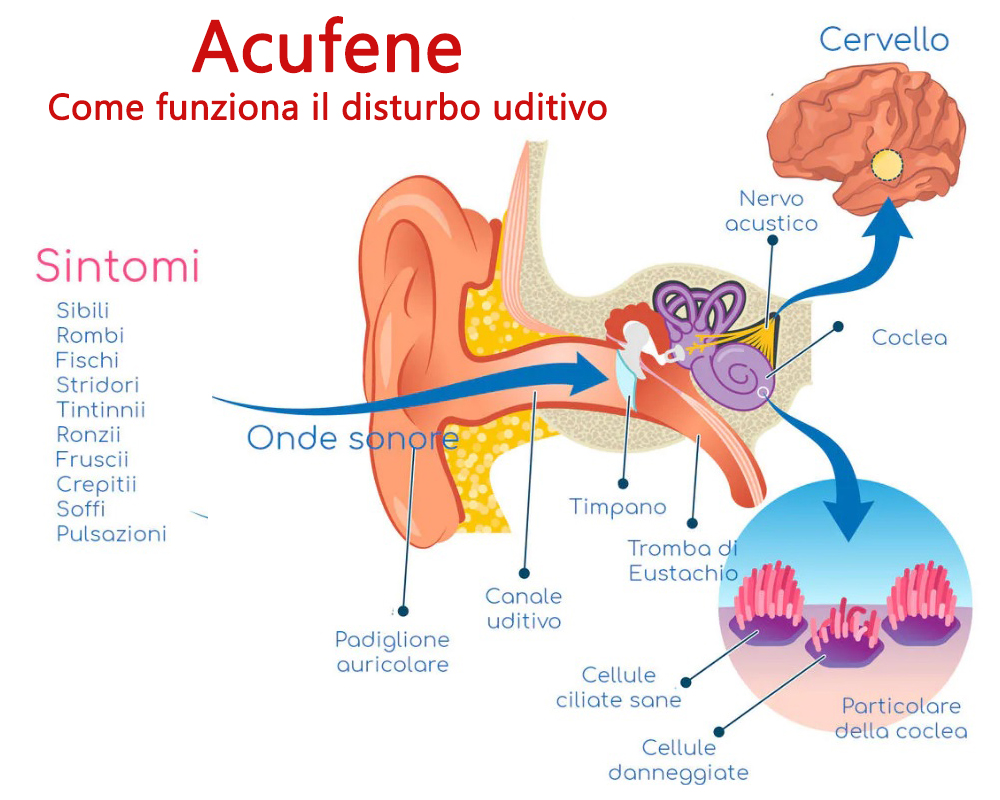 acufene-le-cause-punto-acustico-due